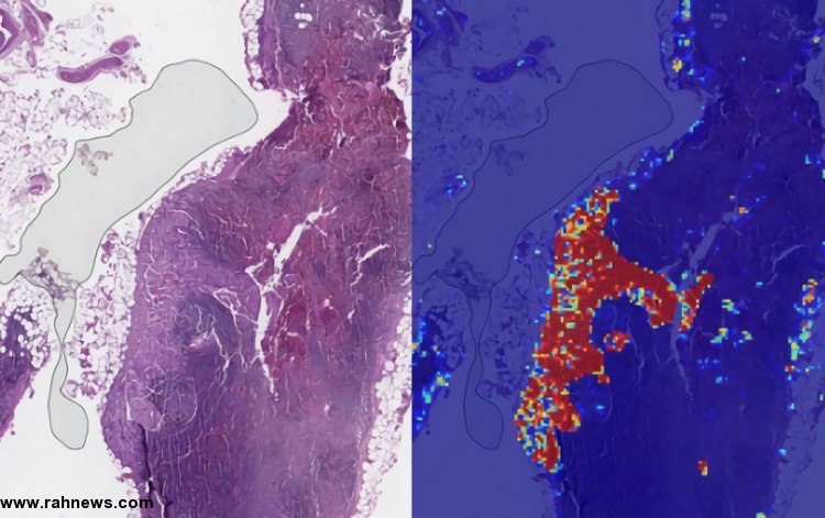 دقت 99 درصدی هوش مصنوعی گوگل در تشخیص سرطان‌های متاستاتیک سینه